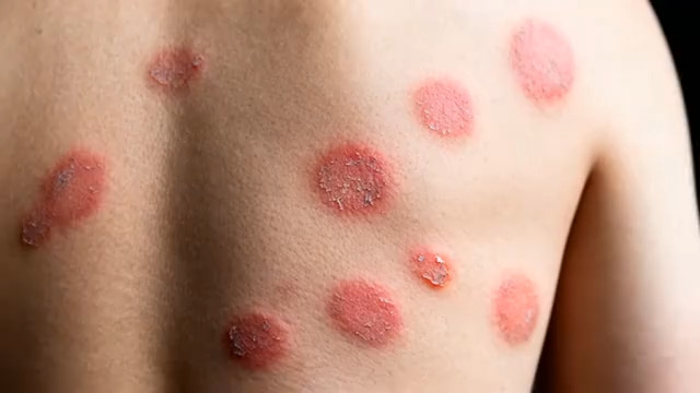  背部红色斑点特写56#横屏 	 