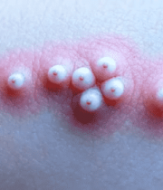 皮肤上的疱疹微距画面558#横屏 